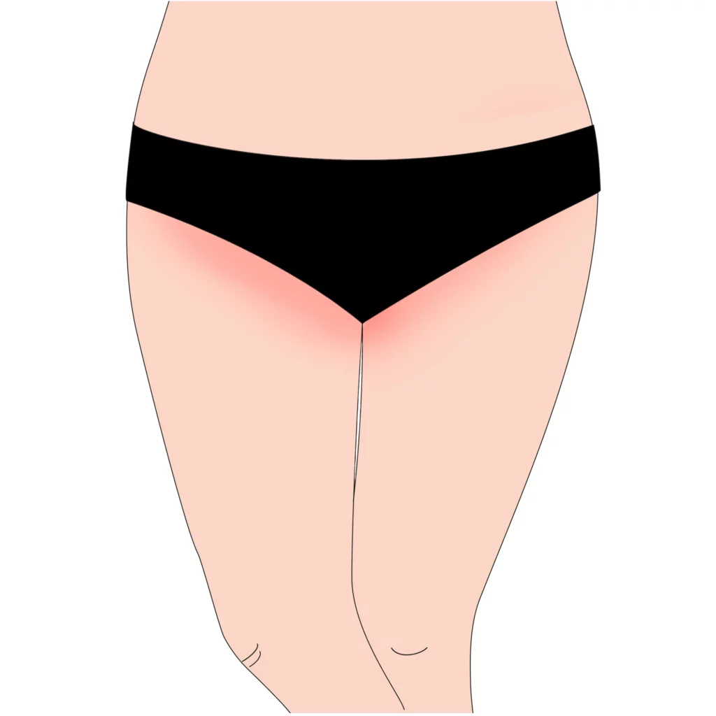 Underlivskollen iriitation